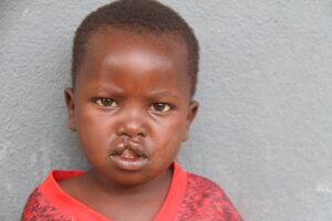 little boy with a cleft llip