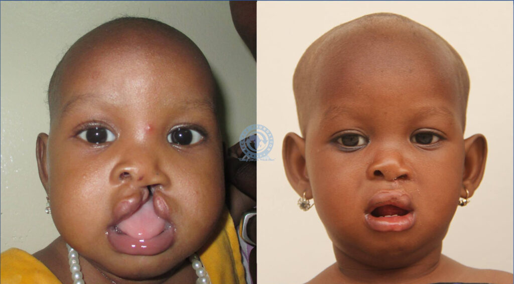 An Update concerning our Comprehensive Cleft Care Project – Weccare ...