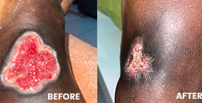 before-and-after-chronic-wounds-weccarefoundation