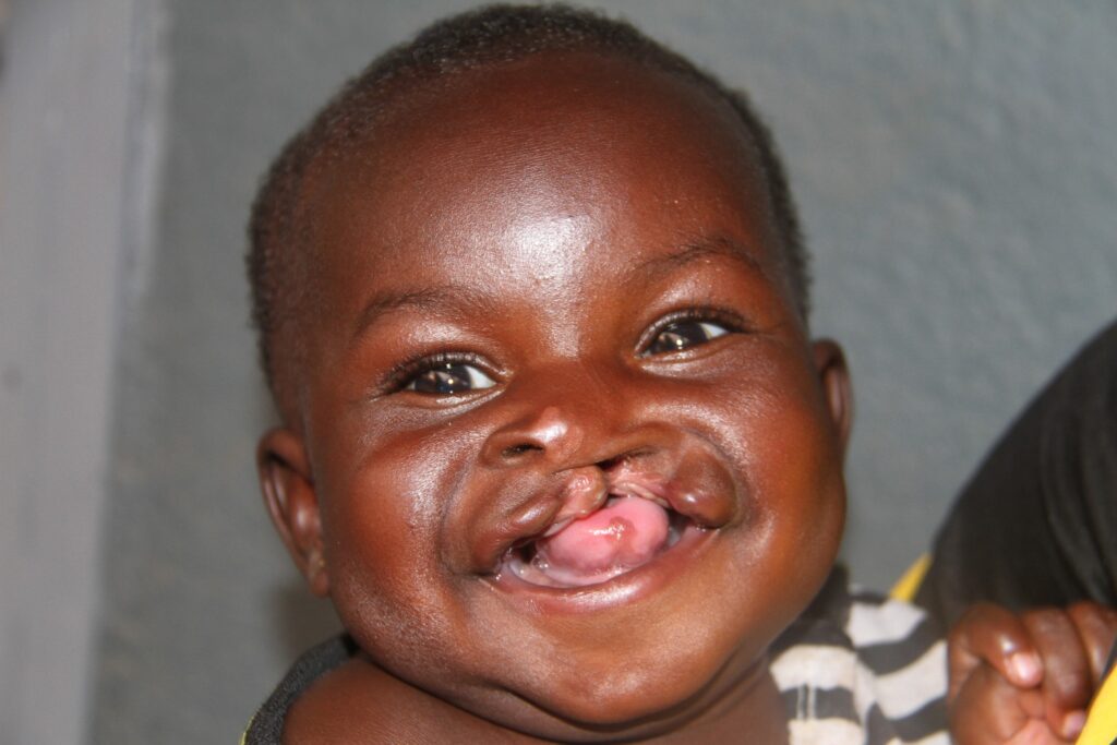 cleft-baby-before