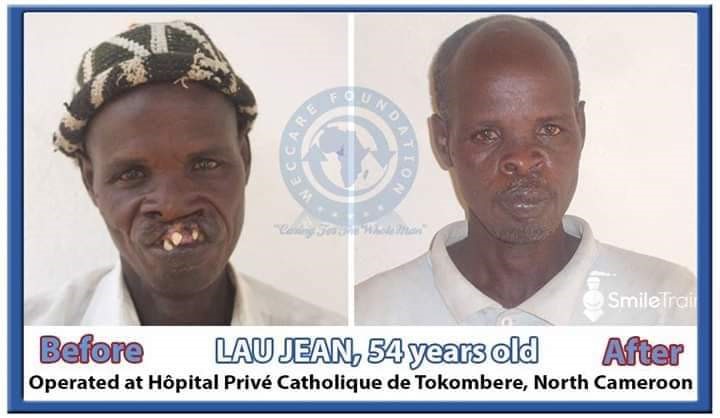 cleft-patient-before-and-after